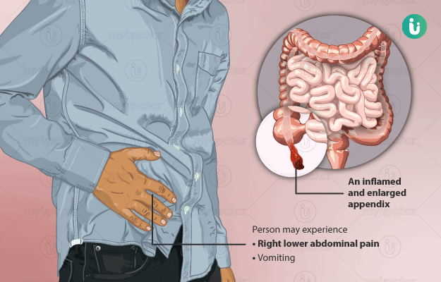 बहुत तेज होता है अपेंडिक्स का दर्द, इन घरेलू तरीकों से पाएं निजात